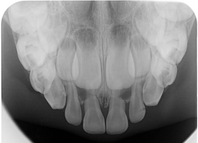 OCCLUSAL X-RAY